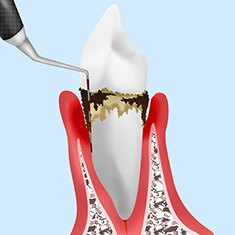 歯周病のこと、正しく知っていますか？