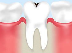 一般虫歯治療
